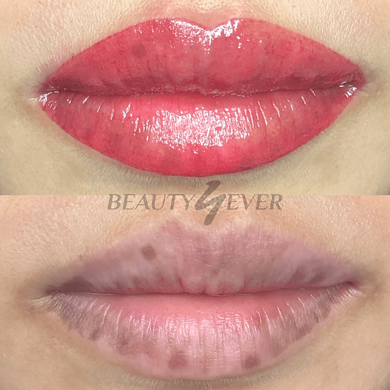 lip treatment midlands